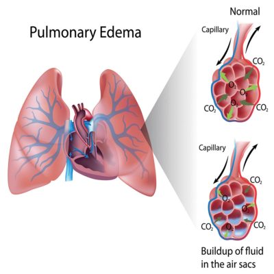 Immersion Pulmonary Oedema: the silent killer - DIVE Magazine